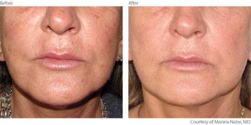 Before And After Photorejuvenation