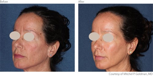 Before And After Non-Ablative Treatment