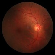 Photocoagulators cauterize eye blood vessels with heat generated by the laser beam