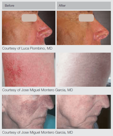 Nd:YAG Laser Before and After