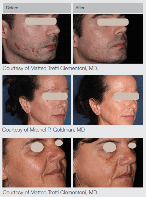 ResurFX Before And After